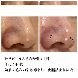 毛穴ケア+ご褒美マスク&ヘッドマッサージ付き💆 ¥12,000→