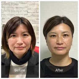 【人気No.１】たるみ引き上げ美容鍼×むくみ撃退小顔矯正　　¥12,000→¥7,980
