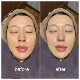 つや肌を手に入れる💎フェイシャルシェービング✨