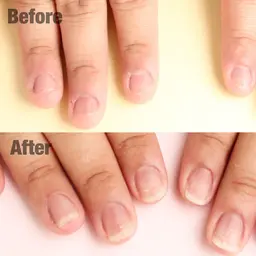 【ミニモ限定】3回コース特別価格￥29,000→￥21,000 深爪矯正長さ出し 1カラーorグラデーション✨ケア付き！