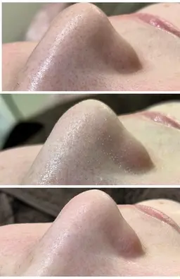 話題沸騰!超 毛穴洗浄! お鼻の黒ずみ綺麗にしてみませんか?選べるパック付き