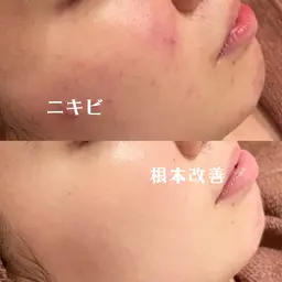 【当日SALE❕❕✨】肌負担0ピーリング&温熱イオンパックでニキビ撃退コース❕❕🤎