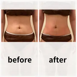 【初回】｟お腹痩せ｠ぽっこりお腹にさようなら！自信のくびれを手に入れる❤️‍🔥【最新痩身機器】