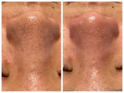 【毛穴大洗浄！！】ハイドラフェイシャル