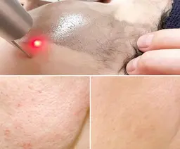 【毛穴特化ケア】Ygレーザ×特殊炭素で詰まり毛穴、開き毛穴ケア ※ダウンタイム無