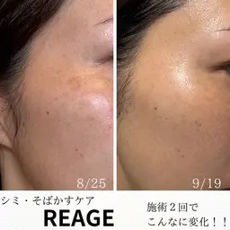 【シミ難民の私を救った】 感動の‼︎シミ、そばかす改善メニュー