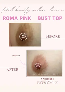 3月中40%OFF更に小顔矯正特典付きバストトップ(ニップル)メラニン除去
