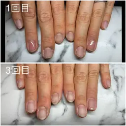 【深爪でお悩みの方おすすめ！】深爪矯正コース