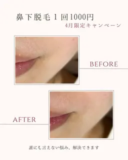 4月限定キャンペーン✨鼻下脱毛1回¥1,000‼️