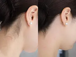 🎀ミニモ限定🎀【うなじ+もみあげワックス脱毛】➕おでこワックス無料✨美人力を高める！ブライダル/イベント前にも