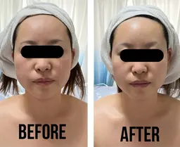 【小顔矯正リフトUP】見た目年齢−10歳も夢じゃない✨リフトアップ&小顔歪み矯正ニュートラルフェイシャル💆♀️70分