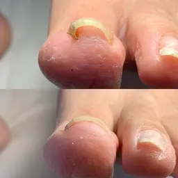 巻き爪＊NAIL trimの巻き爪ケア👣2回目以降は通常チップの貼り替えのみとなります。親指1指