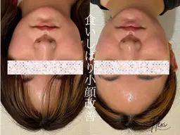 小顔矯正+美容整体コース