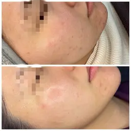 化粧のり!トーンup!ツルツル肌!したい人👤🤍フェイスワックス🫧(シートパック付/高保湿モデリングパック変更可)