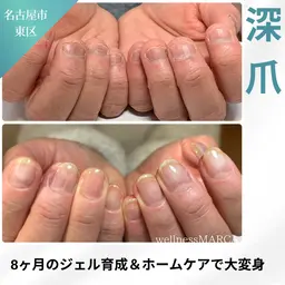 深爪矯正（メンズOK）