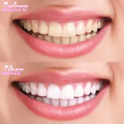 《大好評につき延長!!》大人気セルフホワイトニング3ヶ月通い放題🦷💎