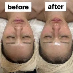 WINBACKフェイシャル30分＋WiQoワイコ®️水光ピーリング