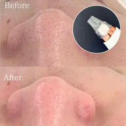 ニョキっと角栓・黒毛穴撃退!!毛穴集中改善フェイシャル