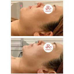 【小顔×肩こり】むくみ集中！ハイパーナイフEXで顔​〜​肩までコリを緩和🔥70分 ¥5,500