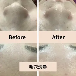 4月15日限定【毛穴洗浄/黒ずみ/ざらつき】毛穴すっきり洗浄＋保湿ケア