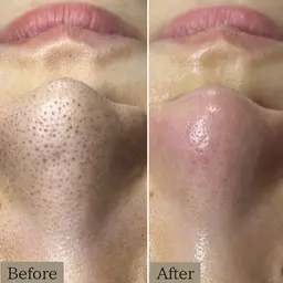 《1番人気》【黒ずみ毛穴ケア＆幹細胞ハーブピーリング】黒ずみゴワゴワ肌をつるん肌へ改善へ✨90分15800円