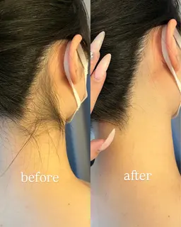 【2026年3月卒業式の方限定✨】うなじ×顔脱毛(シェービング付き)/お得な脱毛でトーンアップ美肌へ!※今年卒業の方限定