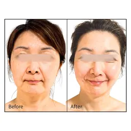 【たるみ・二重アゴ・ほうれい線 改善 】リフトアップエステ