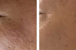 【シミ・シワ・ニキビ跡・開き毛穴】剥離なしハーブピーリング➕ハイドラ毛穴洗浄➕高濃度ビダミンC導入(美白パック付き)