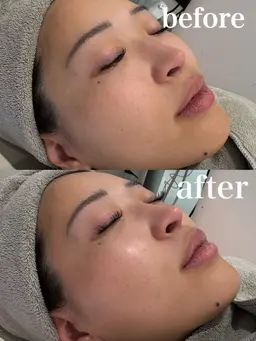 【美肌×小顔】韓国肌管理水光ララピール＆エレクトロポレーション導入✨小顔矯正付🕊️