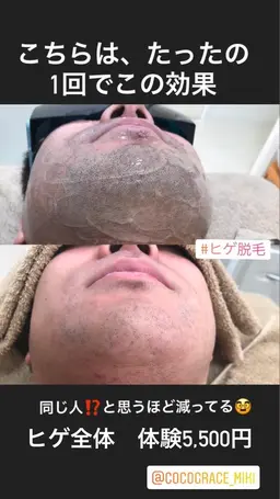 ＜新規＞【Men,s脱毛】（口周り・アゴ・鼻下・頬・フェイスライン）光脱毛1回