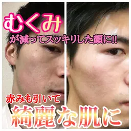 【新成人限定格安メニュー‼️】超お得❤️むくみスッキリ小顔スキンケア☺️