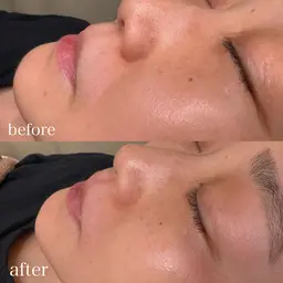 🪞【顔脱毛】お顔の産毛をスッキリ取り除く