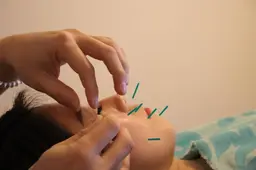 1️⃣美容鍼&美整顔矯正