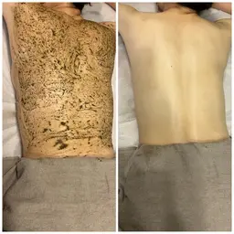 【背中】ハーブピーリング