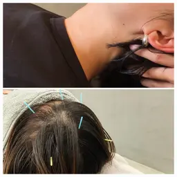 鍼のヘッドスパ