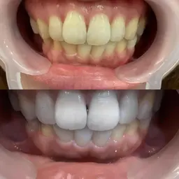 【最強セルフホワイトニング】クリーニング&効果2倍ジェル LED照射15分×2回　¥7000