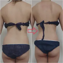 🉐【痩身人気No.1】今すぐ痩せたい！綺麗になりたい方✨ハイパーナイフ痩身100分×3回※条件アリ