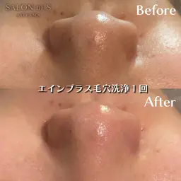 最新毛穴洗浄🫧クリニックで導入されているエインプラスでちゅるちゅる卵肌🥚🤍