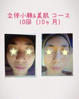 【モニター募集】3D立体小顔矯正術➕美肌➕ヘッドスパ&肩首マッサージ