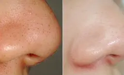 毛穴ピカピカコース