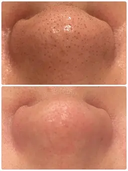 【4月末日まで】【毛穴開き/黒ずみ/いちご鼻】アクアピール+毛穴洗浄×高保湿ポレーション導入