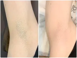 【期間限定】毛穴/ムダ毛改善　ワキ脱毛６回セット2900円　　男女受付可能　ジュニア脱毛OK