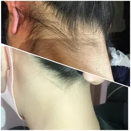 レディース 【うなじ脱毛】 うなじスッキリで首長く、小顔効果✨️!