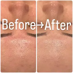 ✨肌質激変✨REVIハーブピーリングで陶器肌へ🌿お肌の悩みを根本から解決します♪[心斎橋/メンズ］