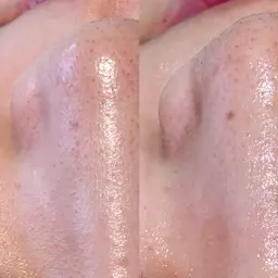 【激推し】話題の肌育成ハーブピーリング［1箇所］🌿一回でも効果実感✨※翌日以降メイク可能