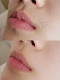 最新機器★全身光脱毛(VIO除く)90分¥28000→¥13000