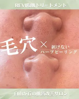 【毛穴の黒ずみ＆開きケア】剥けないハーブピーリング＆鼻集中毛穴洗浄+高濃度美容液導入付き　定価23650円