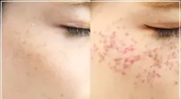 シミ、ホクロ、イボ、取り放題!!気になるしみ、ほくろ、いぼがかさぶたになってポロっと取れる😍