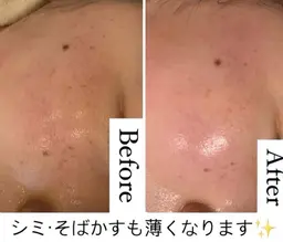 ❤️ツヤハリ+透明肌💖ハイドラ毛穴洗浄全顔+高濃度VC導入+コルギ+デコルテ首肩+美肌LED 💚 60分¥3990