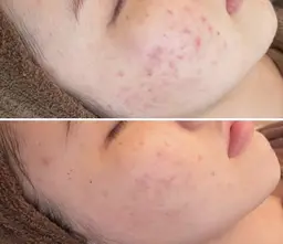 《ニキビケア》ハーブピーリング×炭酸パック♪ニキビ/ニキビ跡が気になる!痛み・DT・剥離なし♪低刺激!ハーブ全顔1g